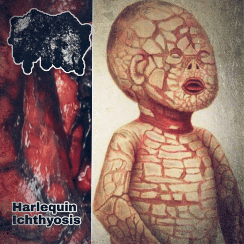 Fetus Demersus : Harlequin Ichthyosis